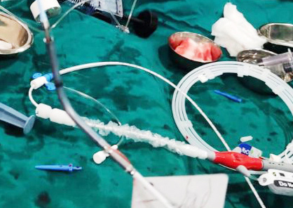 Apollo Cardiologists provide succour to a 61 year old with fatal heart condition using advanced techniques of Impella IVL & OCT! 